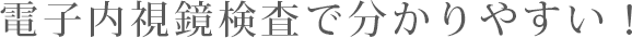 電子内視鏡検査でわかりやすい